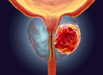 benh-tuyen-tien-liet-o-nam-gioi-1 Ung thư tuyến tiền liệt là một trong những dạng ung thư phổ biến nhất ở nam giới (Ảnh minh họa)