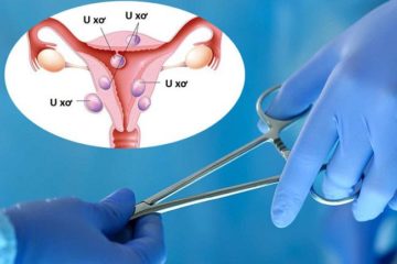U xơ tử cung – nguyên nhân và phương pháp điều trị
